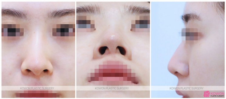 비대칭 콧대와 들린 코끝을 한 번에 잡는 휜코 수술 핵심 정리 관련 이미지 3