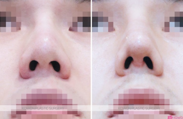 Q. When Is Revision Nose Surgery or Nose Reconstruction Surgery Needed, and Tips for Choosing a Well-Known Revision Nose Surgery Clinic image 9