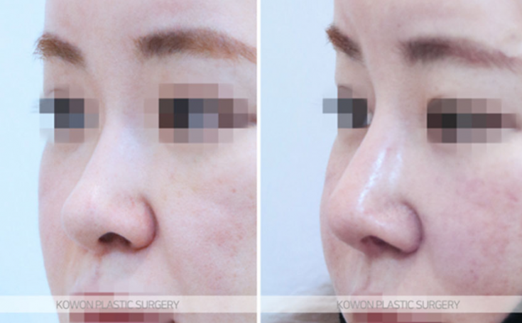 Q. I’m wondering whether my nose surgery swelling period needs more time to look natural, or whether revision surgery is necessary. image 8