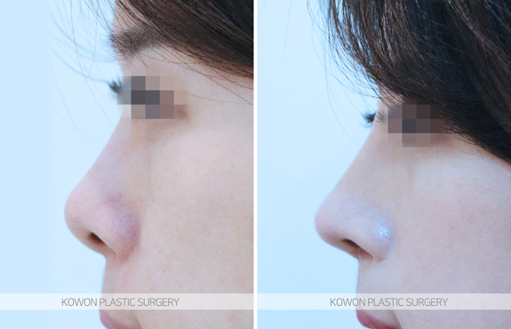 Q. Can upturned nose surgery make uneven nostrils symmetrical if the nose is crooked? image 4