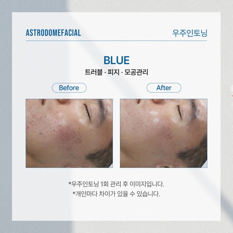 여름철 피지 모공 고민, 피부온도부터 낮춰야 합니다 : 닥터오 추천관리 관련 이미지 5