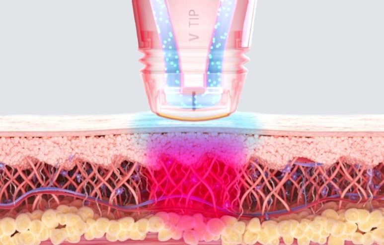 Yeongdeungpo Volnewmer: Restore Sunken Cheeks and Firmness at the Same Time image 3