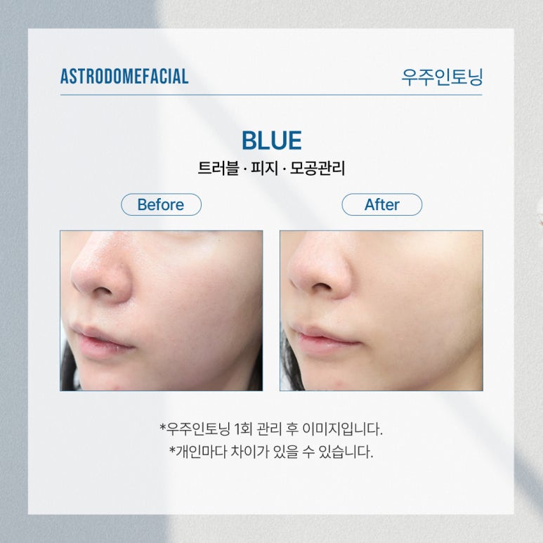 여름철 피지 모공 고민, 피부온도부터 낮춰야 합니다 : 닥터오 추천관리 관련 이미지 4