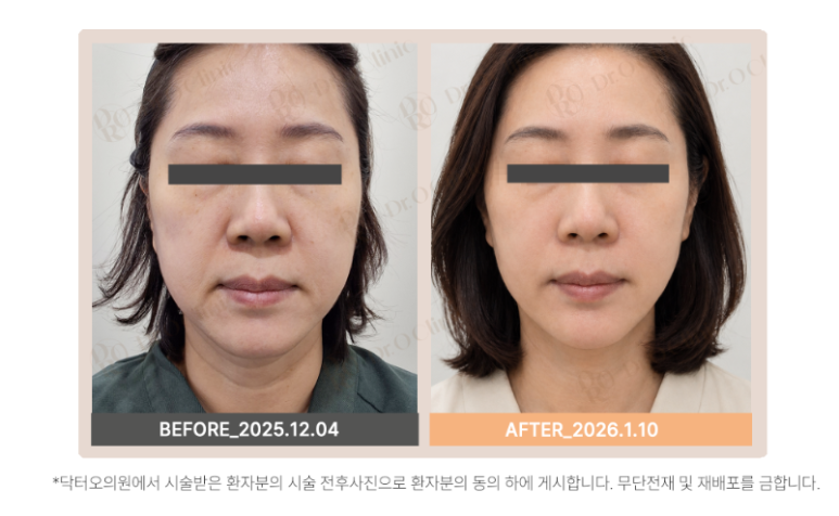 꾸준한 피부관리 시술을 찾으신다면?! 볼뉴머(VOLNEWMER) 관련 이미지 6