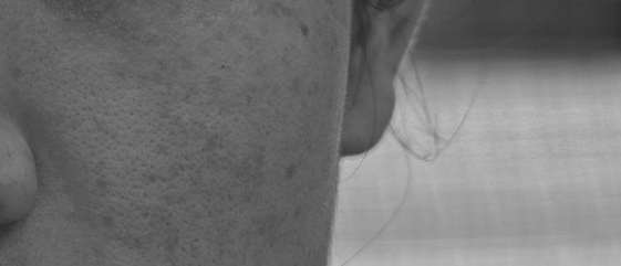 Skin Changes You Can Feel with Yeongdeungpo Pore Treatments image 2
