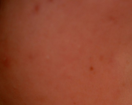 How to Reduce Skin Trouble After Hair Removal in Yeongdeungpo and Keep Skin Smooth image 3