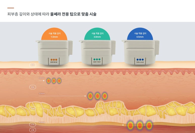 영등포 울쎄라, 리프팅, 탄력, 이중턱까지 관련 이미지 2