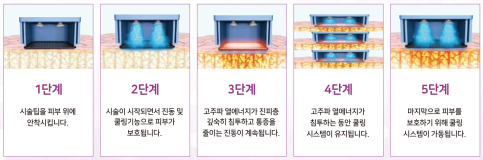 [리프팅] 울쎄라, 써마지 차이가 무엇일까요?! 울쎄라, 써마지에 대한 모든 궁금증을 풀어드립니다. 관련 이미지 4