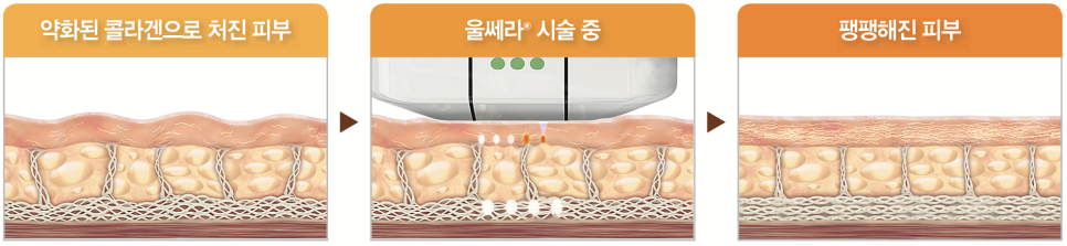 [리프팅] 울쎄라, 써마지 차이가 무엇일까요?! 울쎄라, 써마지에 대한 모든 궁금증을 풀어드립니다. 관련 이미지 1
