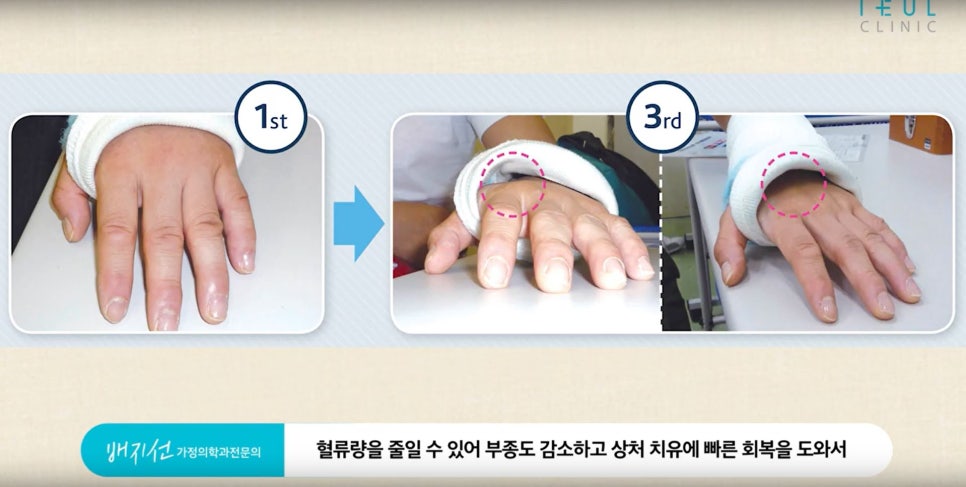 [성형 후 부종] 고압산소치료로 빠른 회복 하세요!! #성형후부종 #서초고압산소 #서초돌발성난청 #성형후상처회복 #성형부작용치료  #이을고압산소 #서래마을고압산소 #반포고압산소 관련 이미지 6