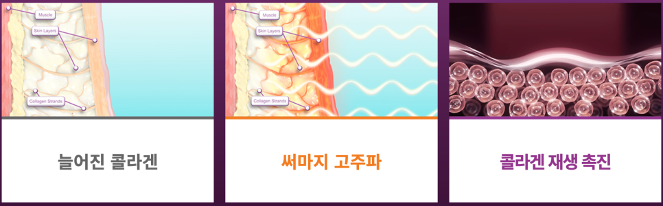 [리프팅] 울쎄라, 써마지 차이가 무엇일까요?! 울쎄라, 써마지에 대한 모든 궁금증을 풀어드립니다. 관련 이미지 2