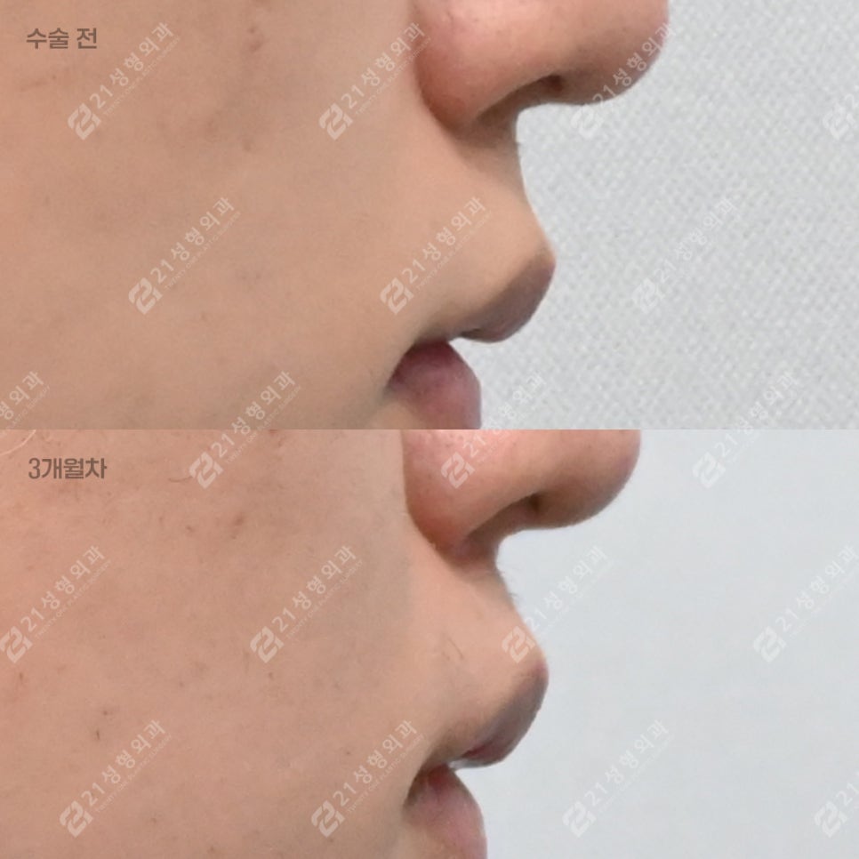 I Almost Gave Up Thinking My Long Philtrum Was Genetic—Until I Finally Looked Into 21 Plastic Surgery image 4