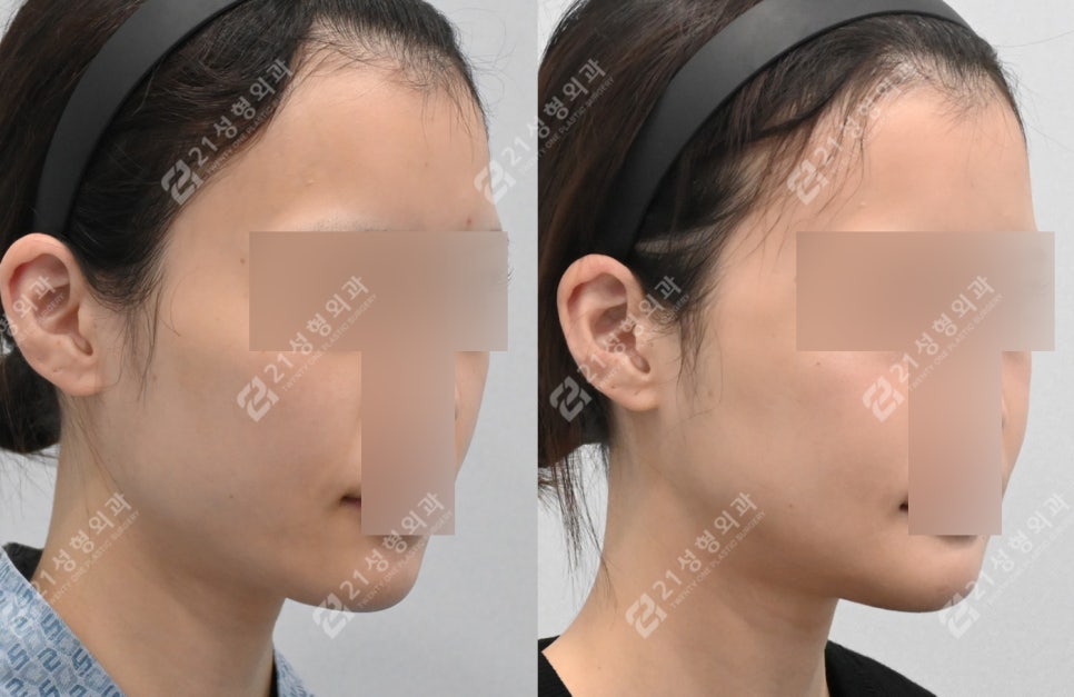 얼굴살이 적으면 윤곽수술 효과가 더 좋을까요? 관련 이미지 2