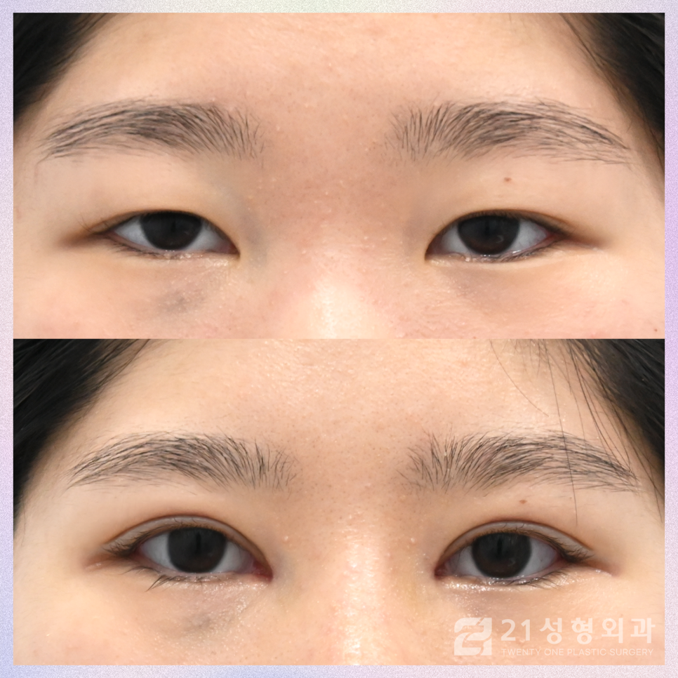 강남눈성형잘하는곳 차이점은 관련 이미지 1