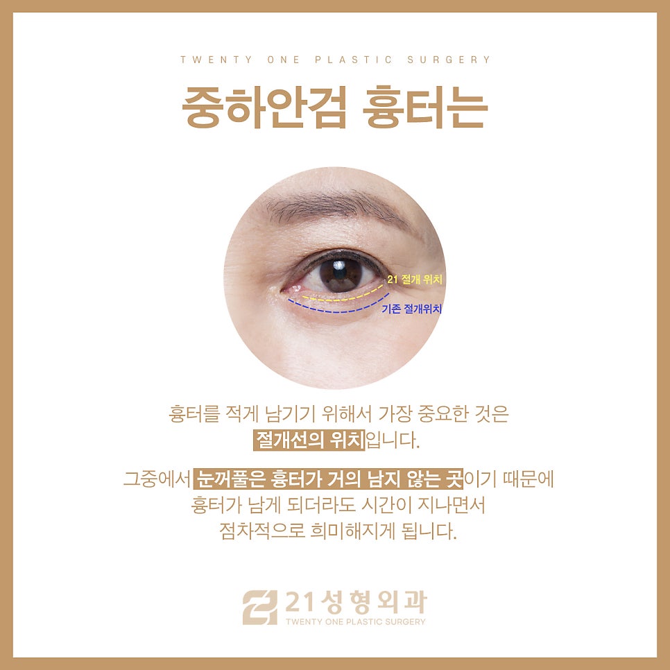 중년하안검 흉터 미리 방지 가능합니다 관련 이미지 5