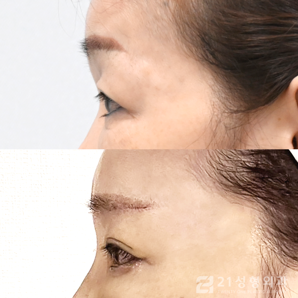 강남눈수술잘하는곳 찾아보고 있다면 관련 이미지 3
