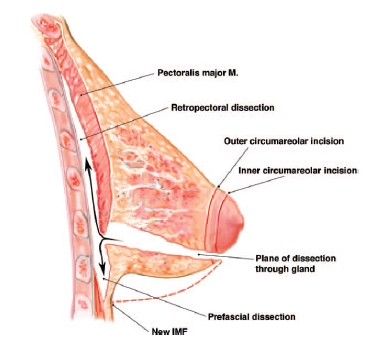 관상형 유방 (Tubular breast) 관련 이미지 8