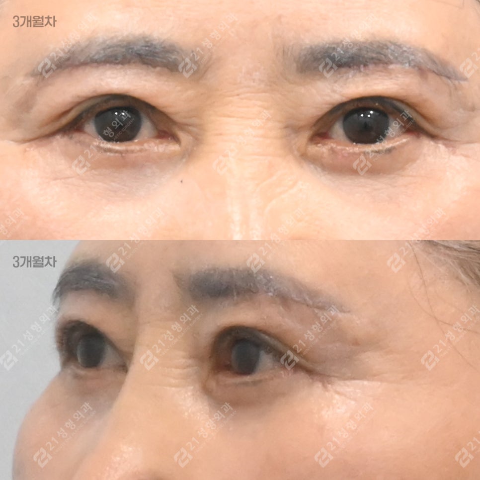 If You Keep Tensing Your Forehead, Consider Eyelid Drooping image 5