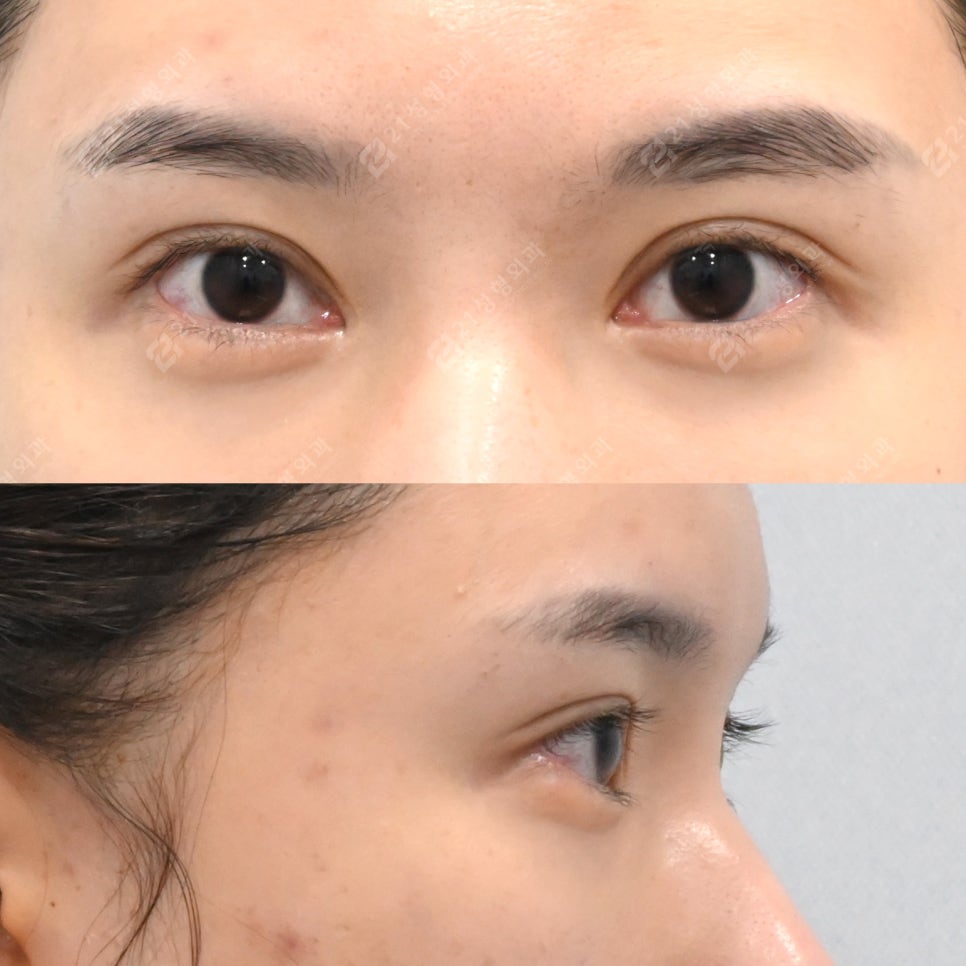 Why the under-eye area looks even more tired: your under-eye surgery may have gone wrong image 4