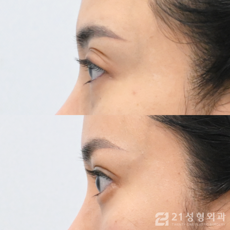 강남역눈매교정 이미지 개선을 원한다면 관련 이미지 3