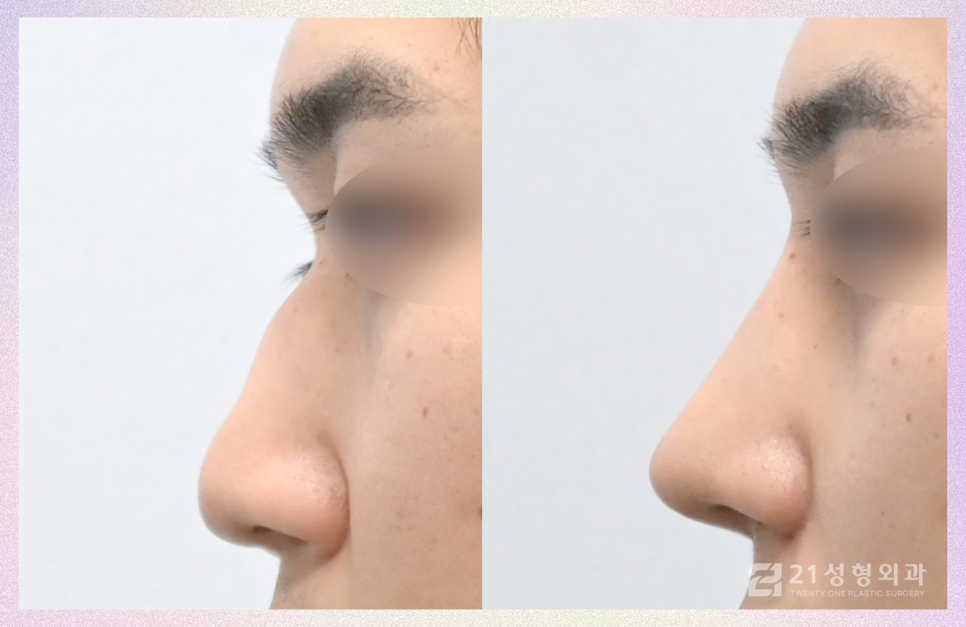 강남남자코수술 잘하는 병원의 기준 관련 이미지 3