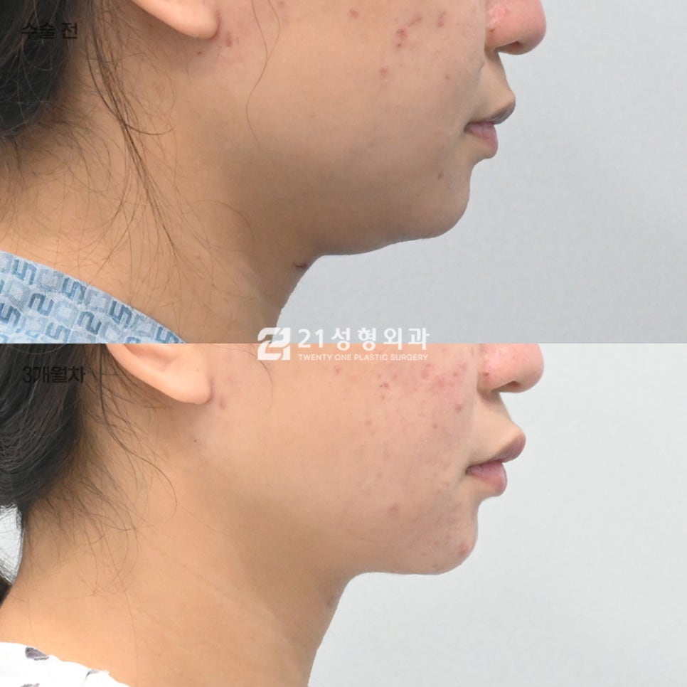 스트레스인 턱밑 살, 진짜 범인은 따로 있습니다. 관련 이미지 1