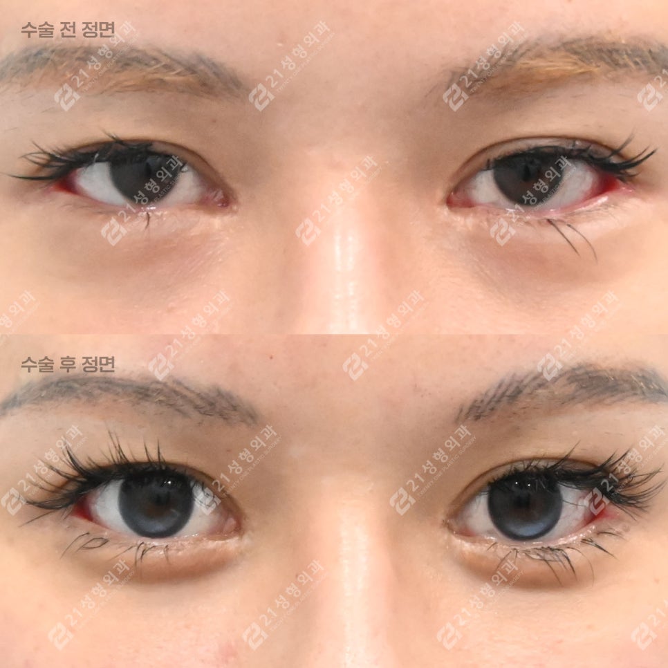 The Reason Lower Eyelid Fat Repositioning Is Needed, Explained Through the Structure Under the Eyes image 1