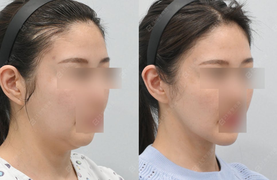 Real Review: A Smooth Improvement of Leftover Double Chin and Jowl Fat Even After Dieting image 8