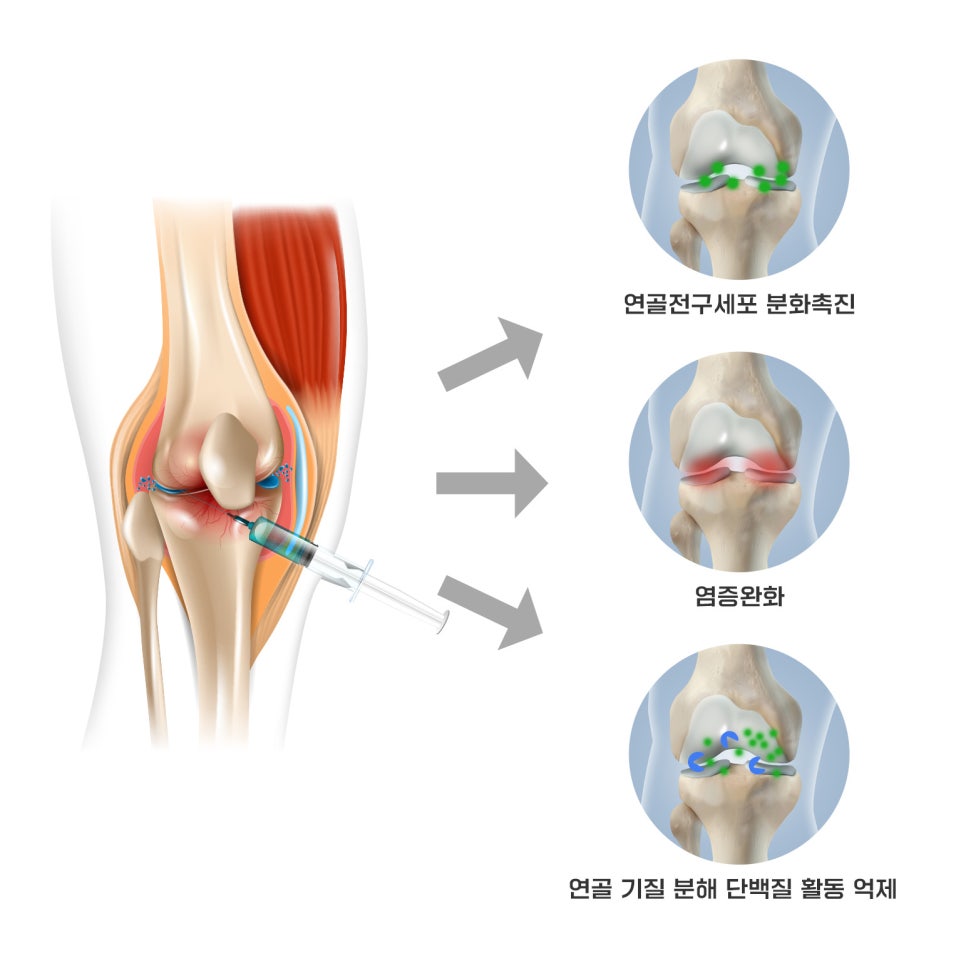 자가줄기세포가 가져온 무릎 통증 치료의 새 시대 관련 이미지 4