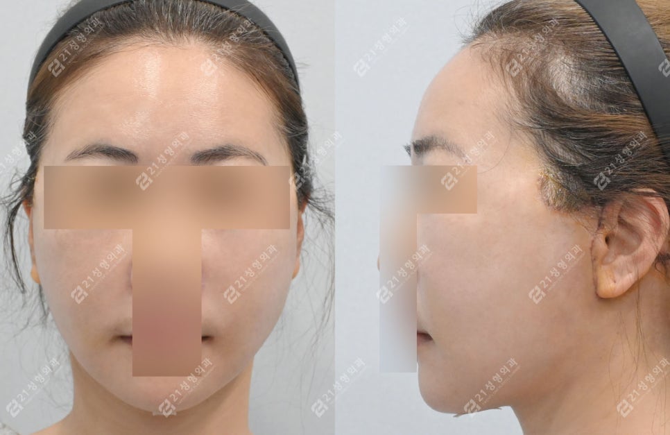Facial and Neck Lift: The Key Is Structure, Not Skin | Real Before-and-After Review image 4