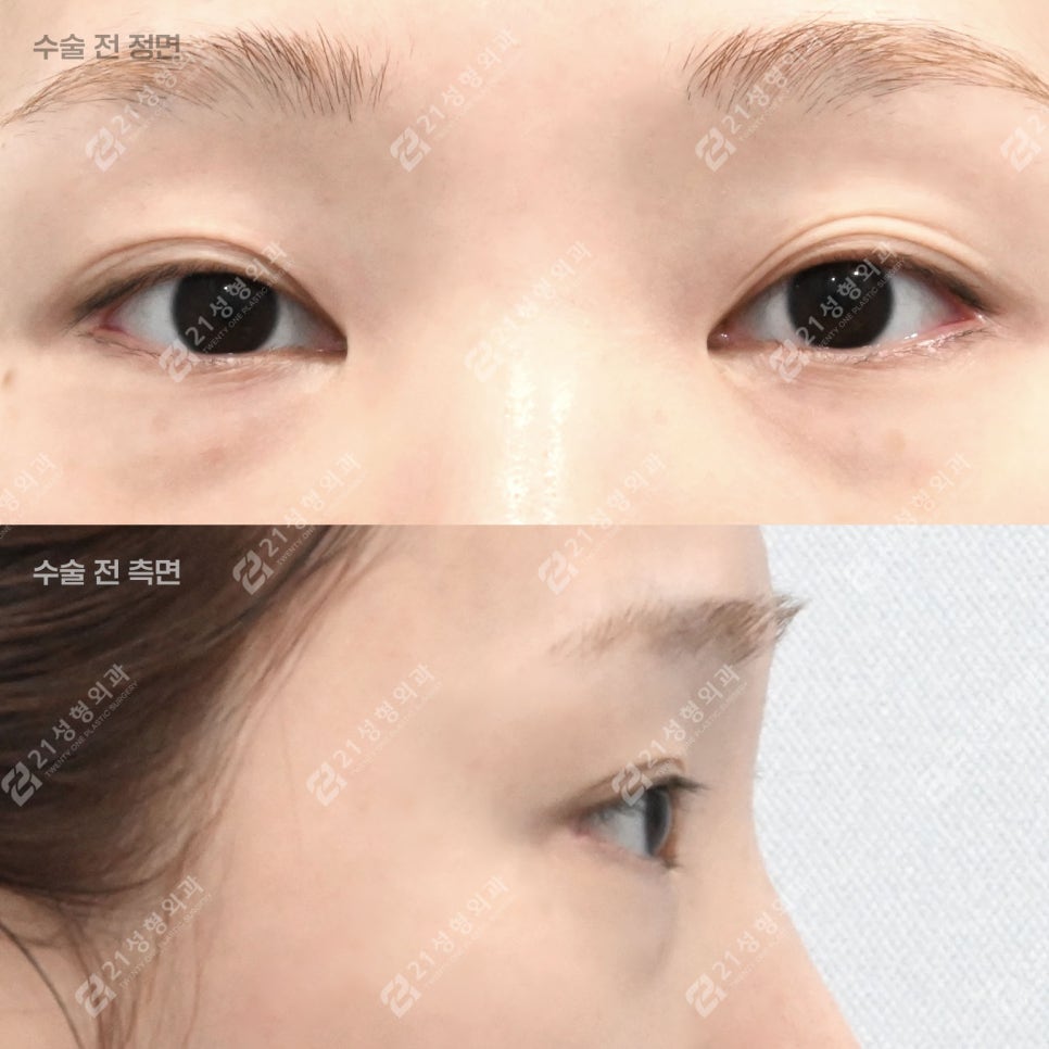 Dark Circles, Caused by Lack of Sleep? Lower Eyelid Fat May Be the Reason! image 2