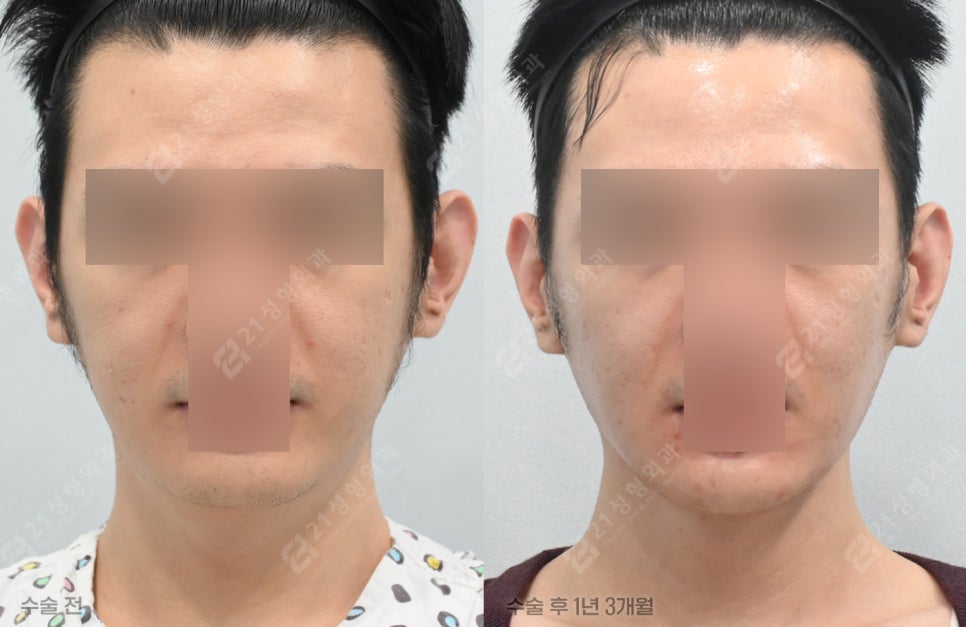 Have You Regretted Having Only Double-Chin Liposuction? Why Muscle Tightening May Be Needed for Successful Double-Chin Surgery image 2