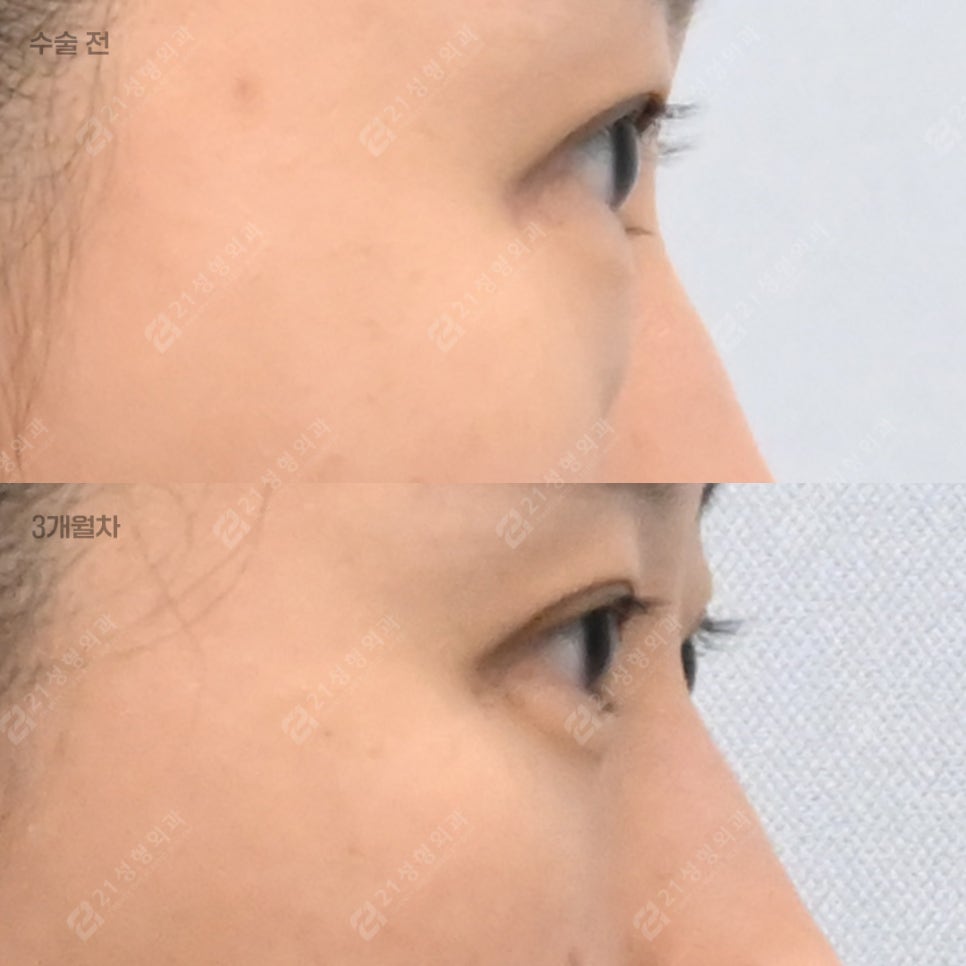 With Lower-Eyelid Fat Repositioning and Fat Grafting: The Real Reason Your Eyes Look Different image 7