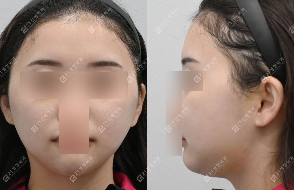 작은 얼굴이지만 윤곽 3종이 필요한 케이스: 턱끝 전진형 얼굴 분석 관련 이미지 3