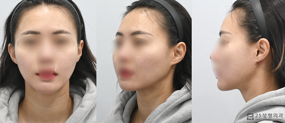 이중턱근육묶기잘하는곳 확실하게 알아보려면 관련 이미지 5