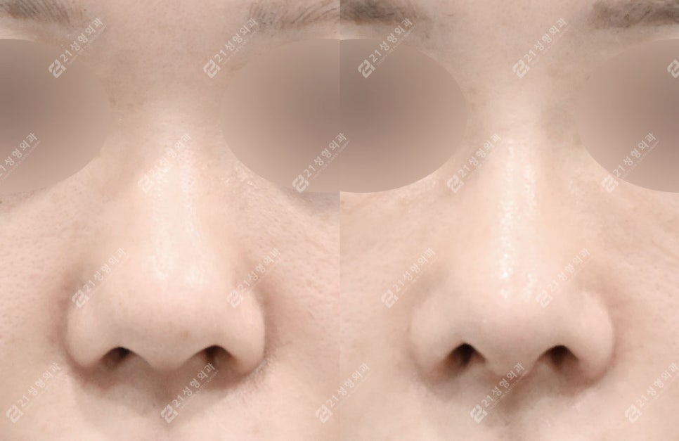 How to Create a Flawless Nose Line | Real Review of Rib Cartilage Rhinoplasty image 4