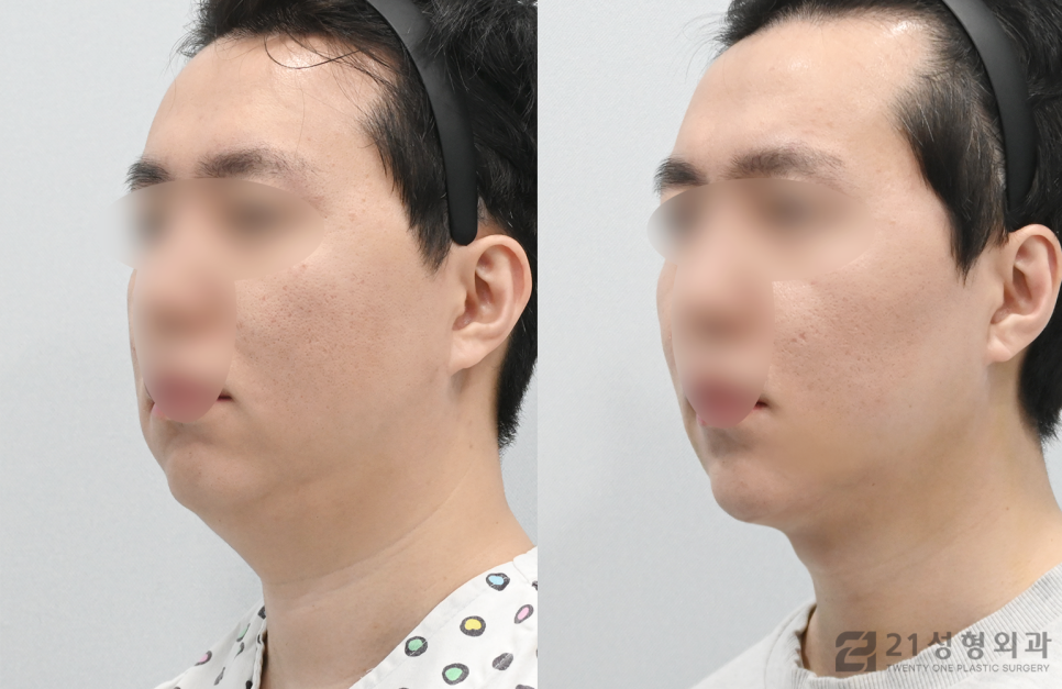 이중턱살빼는방법 갸름한 얼굴라인 비결 관련 이미지 2