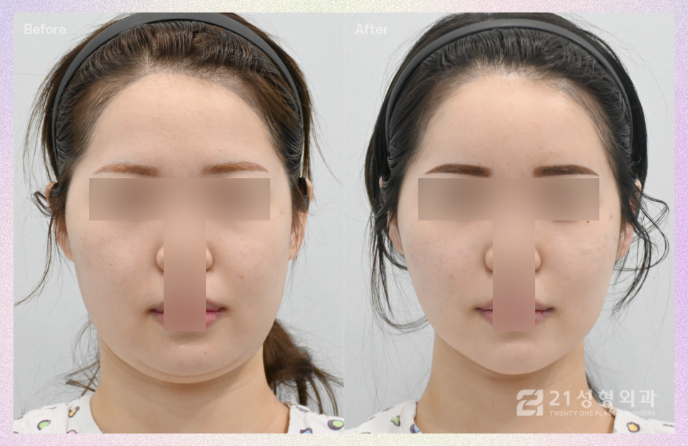 이중턱흡입 후 뚜렷해진 턱 라인 관련 이미지 1