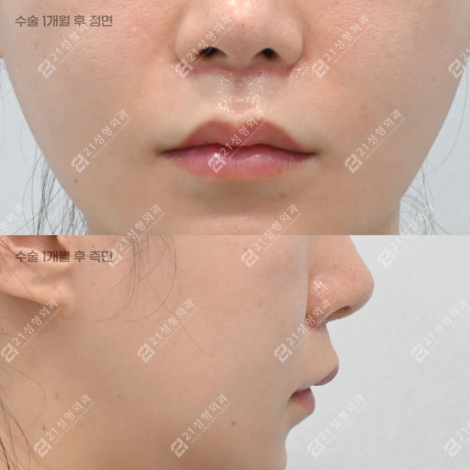 Lip Lift Review | What Matters More Than Length Is Facial Proportion! image 4
