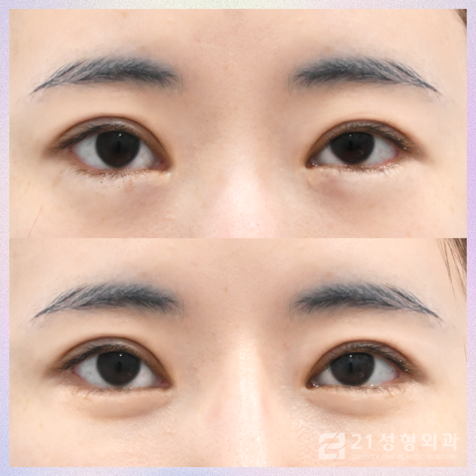 눈밑지방재배치수술잘하는곳 21성형외과에서 관련 이미지 1