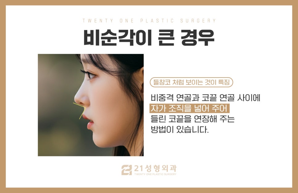 비순각교정만으로로 양악 효과 만들 수 있습니다 관련 이미지 6