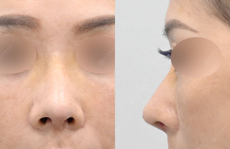 A Real Nose Surgery Review That Combines Safety and Naturalness image 3