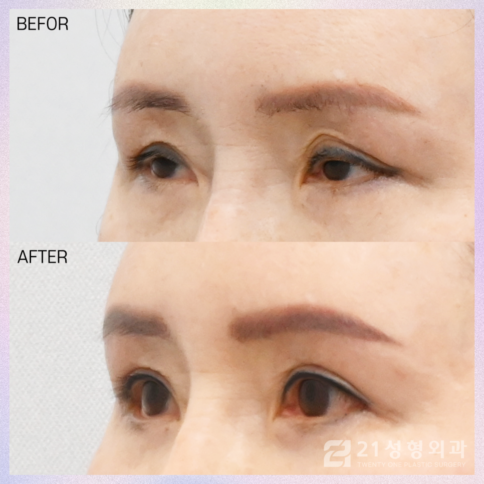 상안검수술흉터 걱정되신다면 관련 이미지 3
