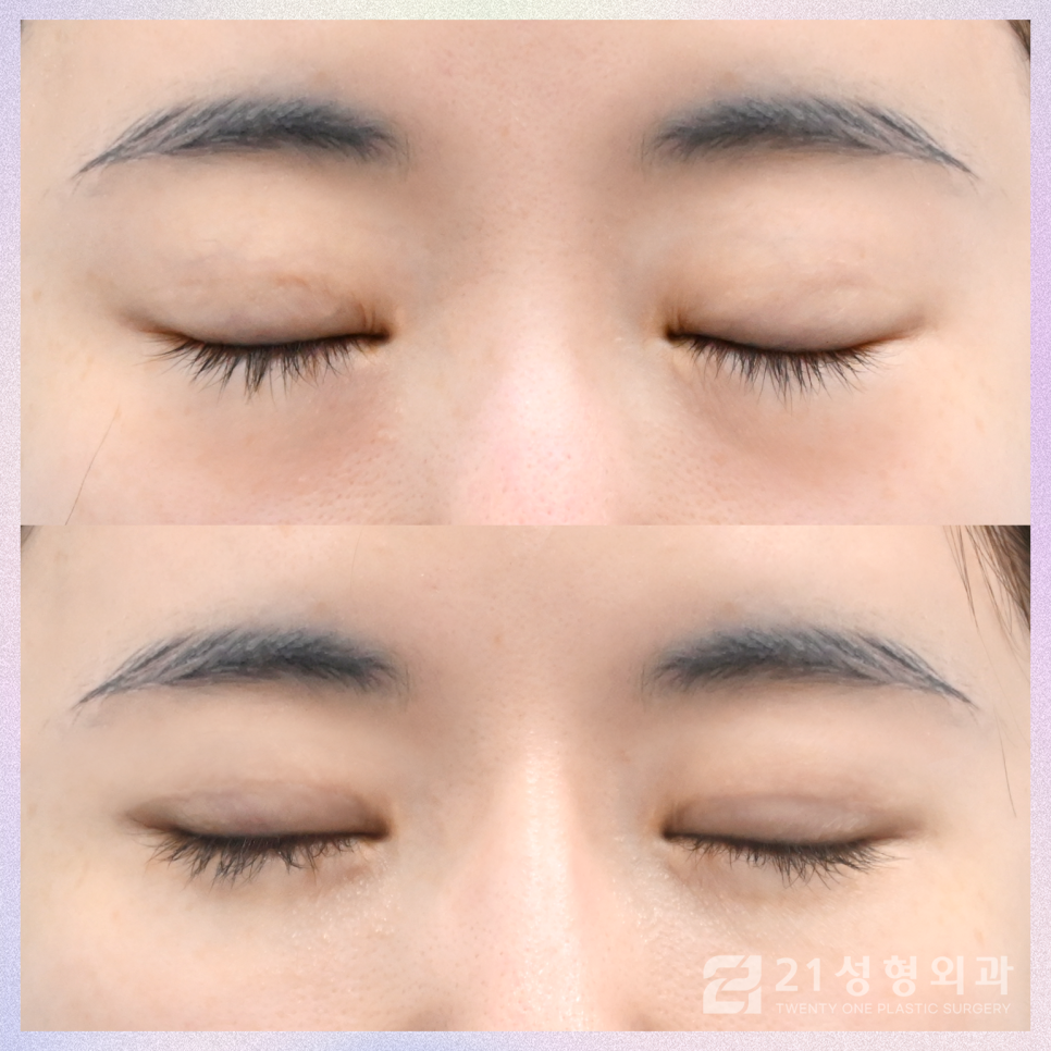 눈밑지방재배치수술잘하는곳 21성형외과에서 관련 이미지 3