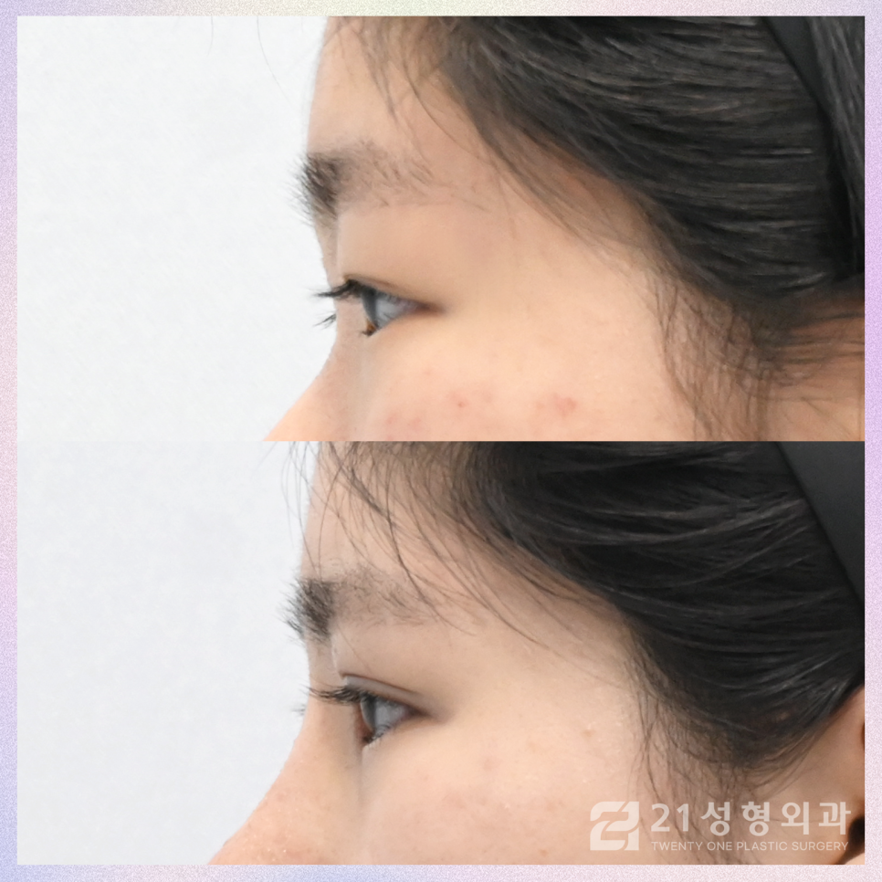 강남눈성형잘하는곳 차이점은 관련 이미지 5