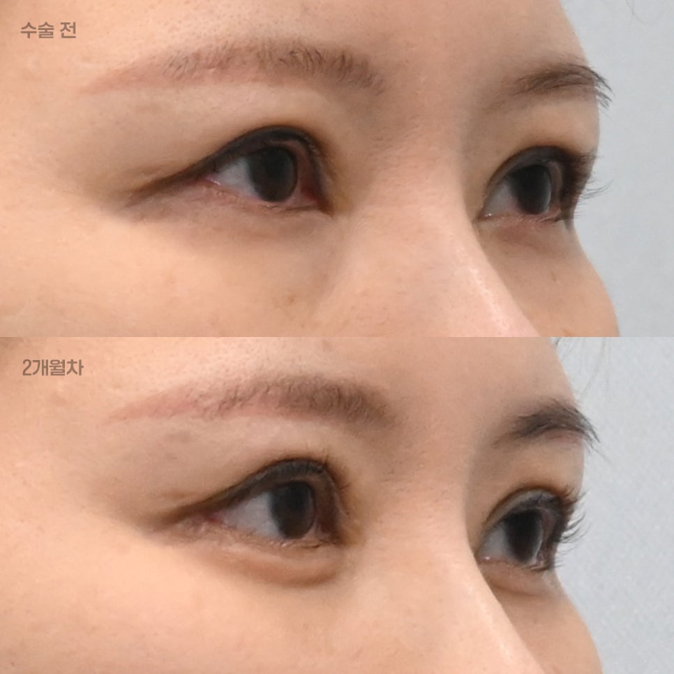 What Is the Most Efficient Combination of Plastic Surgery Procedures That Can Be Completed at Once, Without Going Through the Same Ordeal Twice? image 2