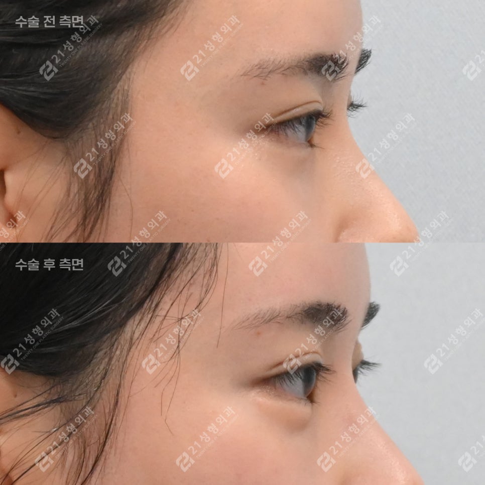 Key Points That Change Your Impression: Under-Eye Fat Repositioning and Nano-Pet Fat Grafting image 6