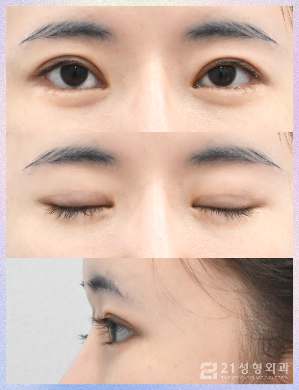 눈밑지방재배치수술잘하는곳 21성형외과에서 관련 이미지 7