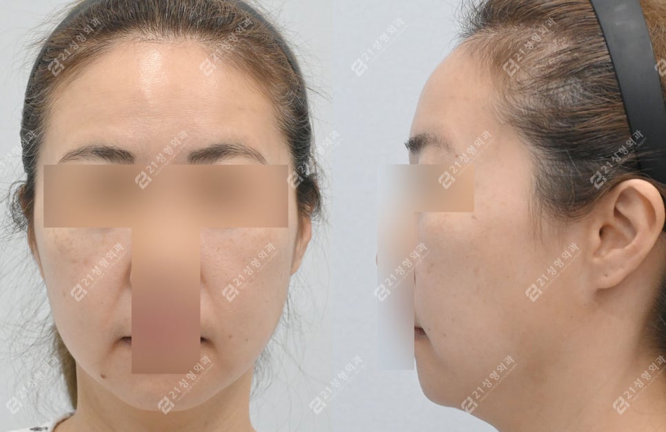 Facial and Neck Lift: The Key Is Structure, Not Skin | Real Before-and-After Review image 2