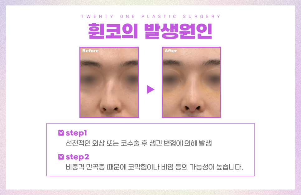 휜코성형 기능적인 문제까지 체크하면 관련 이미지 3